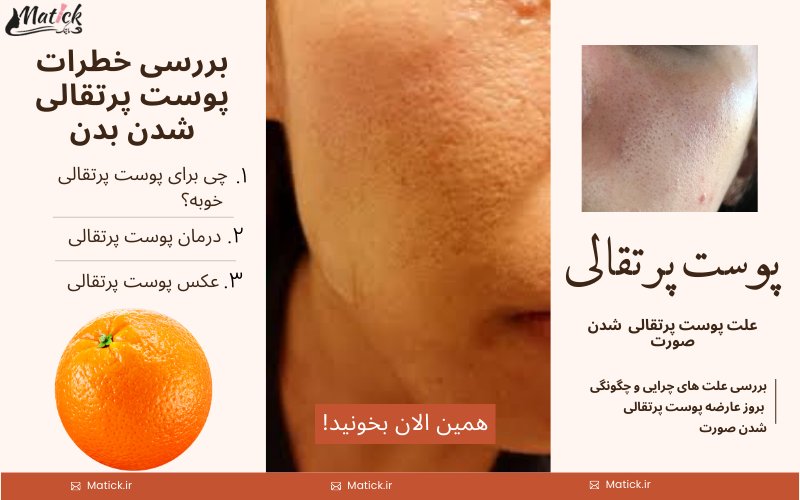 پوست پرتقالی